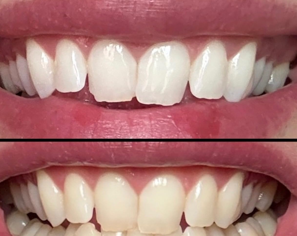 Crest Teeth Whitening Strips, Crest 3D Whitestrips Professional Effects, Enamel Safe Teeth Whitening Kit, 22 Treatments (44 Strips), Professional-Level Whitening, 19 Levels Whiter customer photo 1