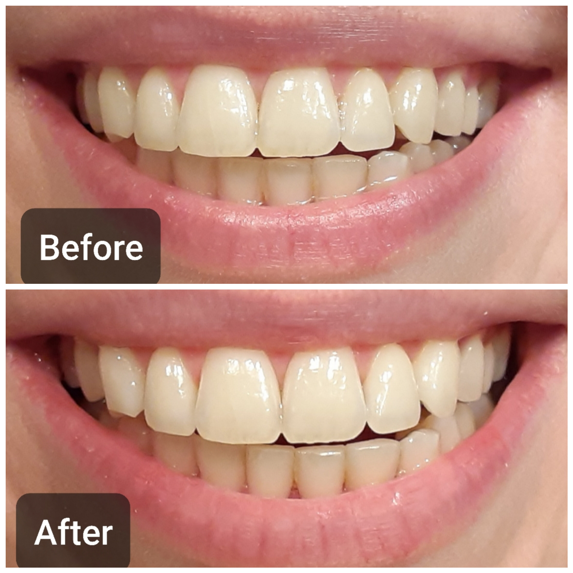 Auraglow Teeth Whitening Kit, LED Accelerator Light, 35% Carbamide Peroxide Teeth Whitening Gel, 20+ Whitening Treatments customer photo 1