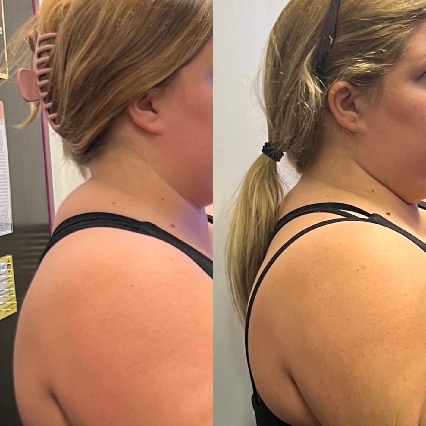 Backpod - Premium Device for Costochondritis & Tietze Syndrome | Physio Designed | NZ Made | Posture Corrector & Back Pain Relief customer photo 1