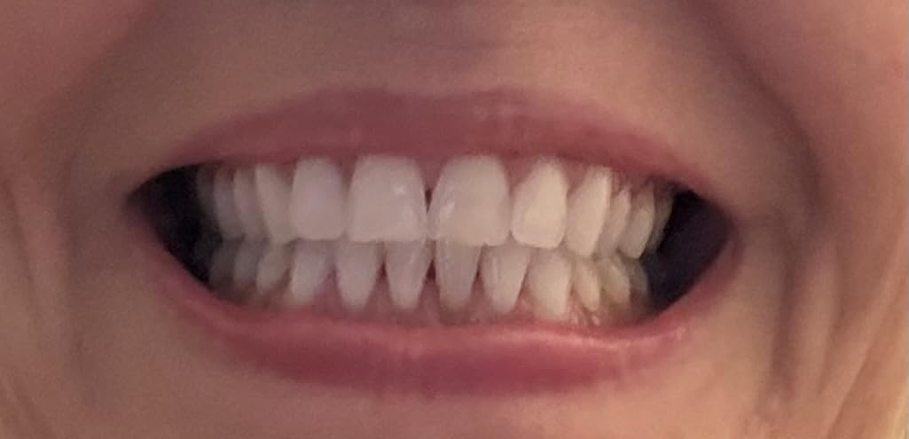 Novashine Professional Teeth Whitening Kit: Advanced Blue LED Light, Concentrated Peroxide Gel, Smartphone Adapter, Travel Bag customer photo 1