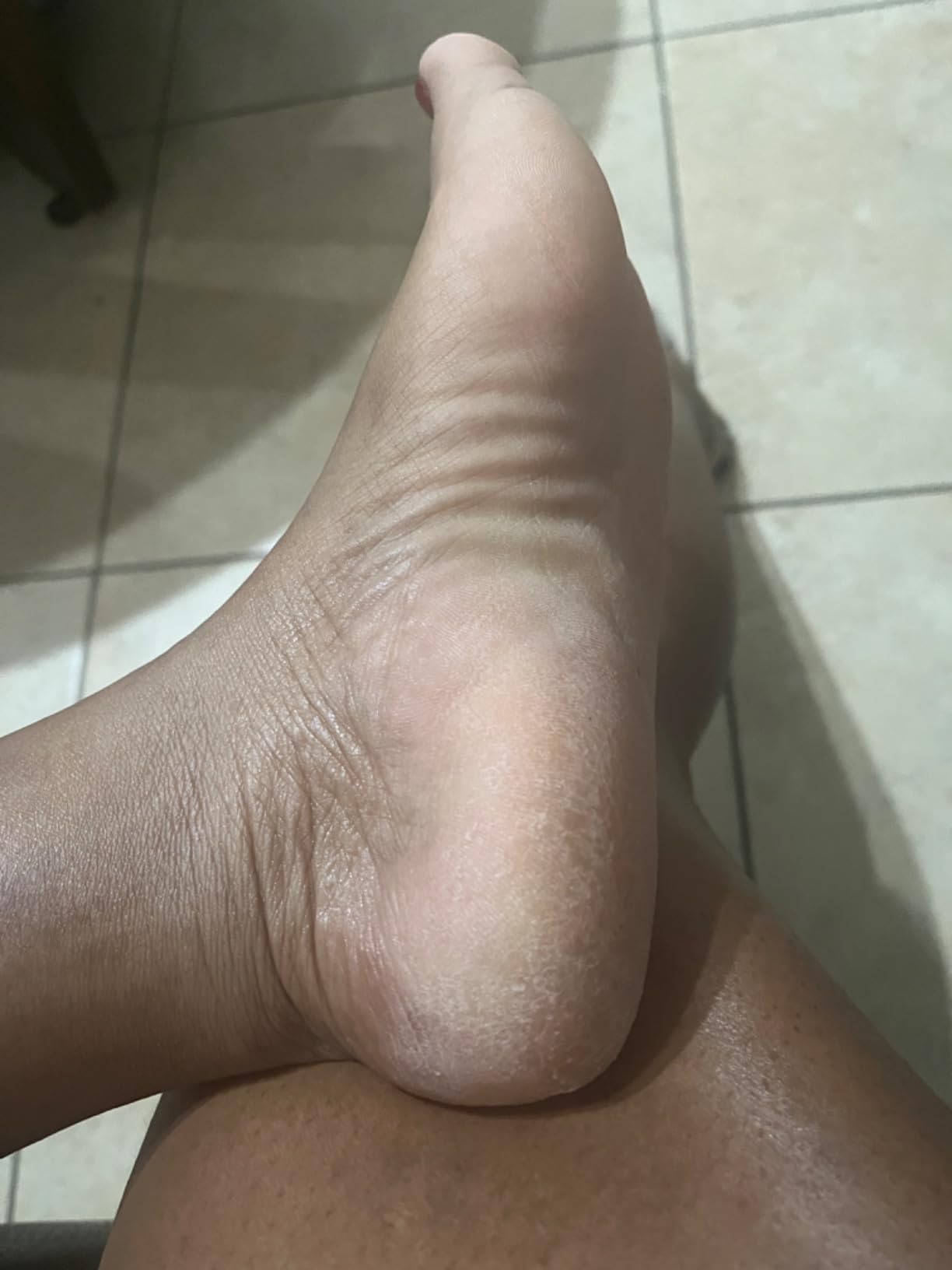 DERMORA Foot Peel Mask, Exfoliating Foot Peeling Mask, 2 Pairs, Original | Dry and Cracked Feet, At-Home Spa Care, Callus Removal & Smoother Skin Result, Regular Size (Fits up to Woman 11, Men 10) customer photo 1