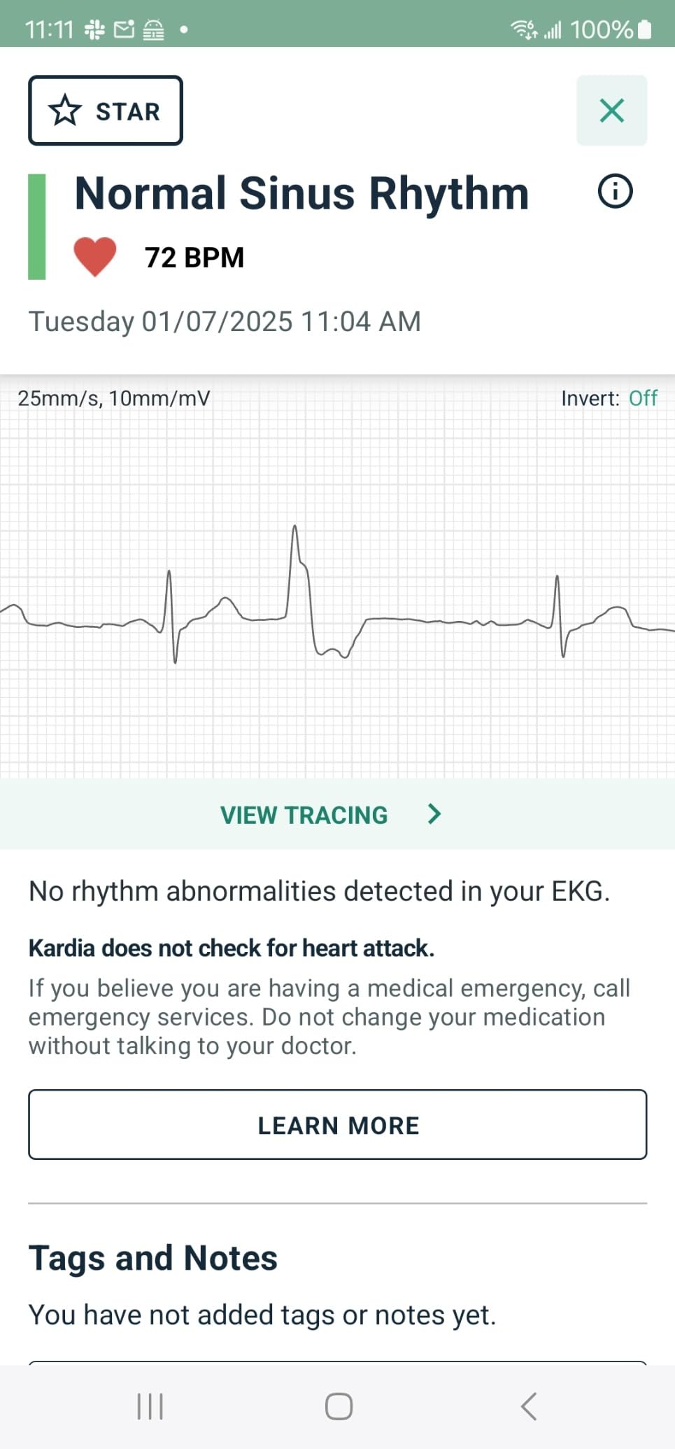 KardiaMobile 6-Lead Personal EKG Monitor - Six Views of The Heart - Detects AFib and Irregular Arrhythmias - Instant Results in 30 Seconds - Works with Most Smartphones - FSA/HSA Eligible customer photo 2
