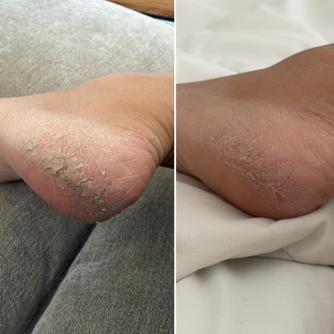Ebanel Urea Cream 40% plus Salicylic Acid 2% for Dry Cracked Feet Skin | Deeply Moisturizes & Softens Dry Cracked Heels, Feet, Knees, Elbows, Hands, Rough Dead Skin Callus Remover Toenail Softener customer photo 1