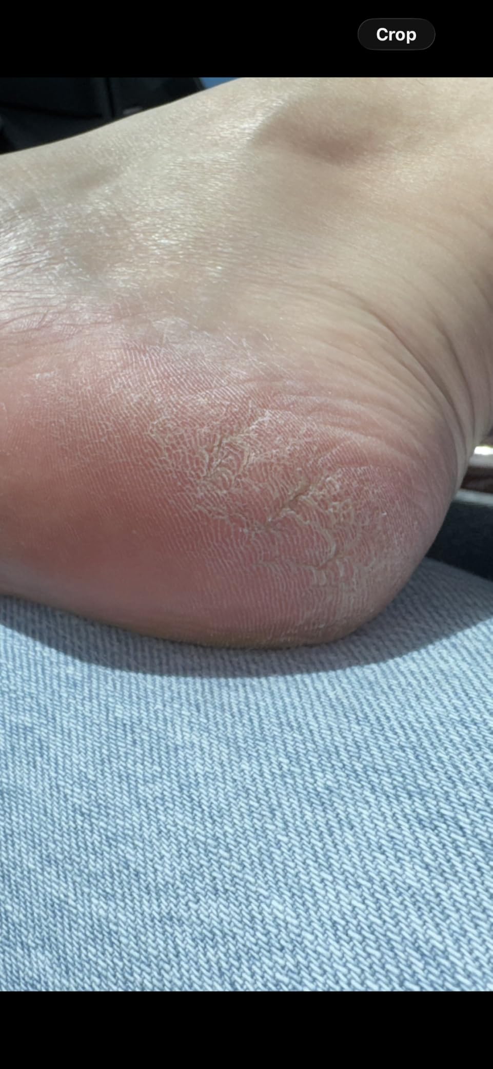 Ebanel Urea Cream 40% plus Salicylic Acid 2% for Dry Cracked Feet Skin | Deeply Moisturizes & Softens Dry Cracked Heels, Feet, Knees, Elbows, Hands, Rough Dead Skin Callus Remover Toenail Softener customer photo 2