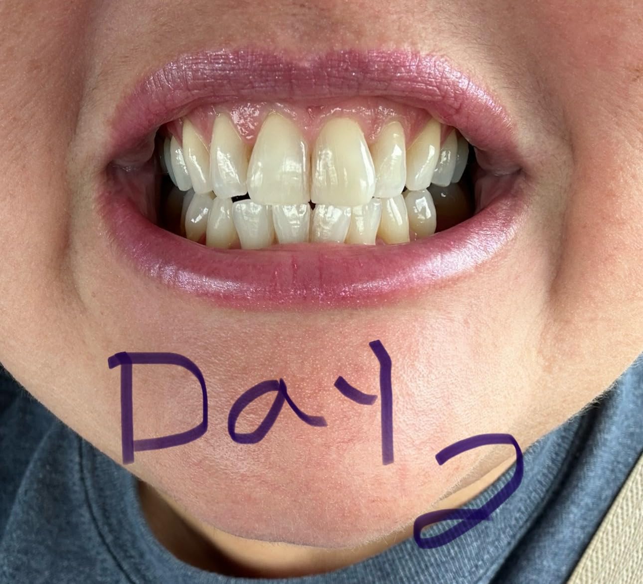 Crest 3D Whitestrips Professional White with Hydrogen Peroxide + LED Light Teeth Whitening Kit - 19 Treatments customer photo 1