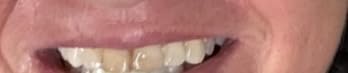 Crest 3D Whitestrips Professional Effects + LED Light - Teeth Whitening Kit, 1 Light + 20 Treatments, 40 Strips customer photo 1