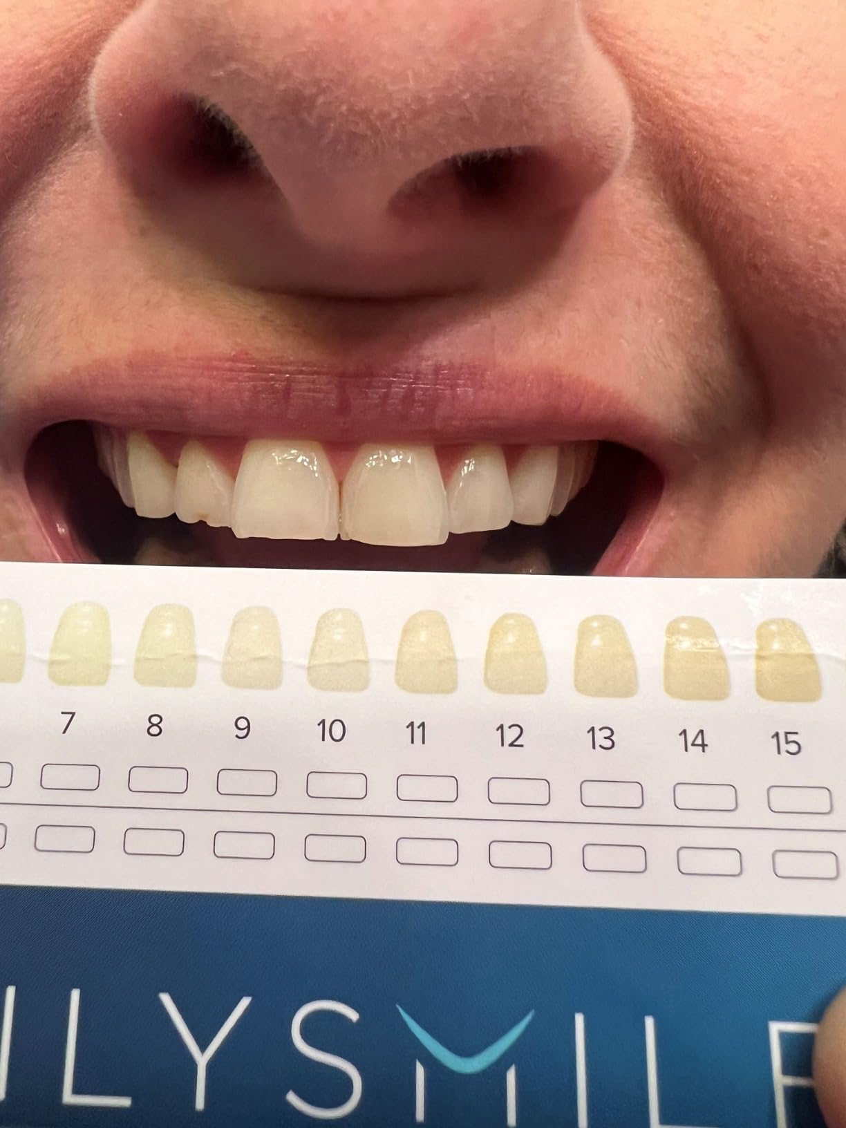 Teeth Whitening Kit with LED - Formulated for Sensitive Teeth, Hands-Free, Waterproof LED Light and 4 Gel Pens, Instant Results customer photo 2
