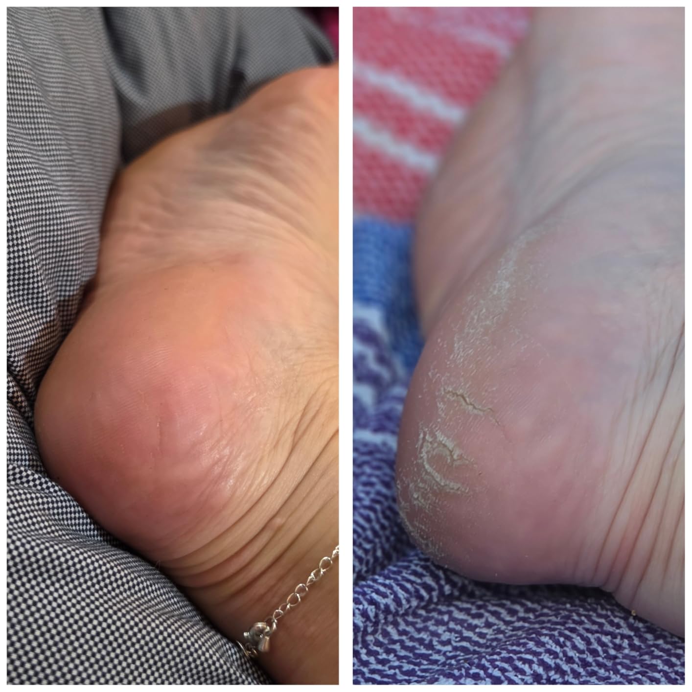 Dr. Scholl's Callus Remover Electronic Foot File, Electric Hard Skin Removal for Feet, Effortless Soft Smooth Skin in Minutes, Perfect for Travel, for Women & Men, AAA Batteries Included customer photo 1
