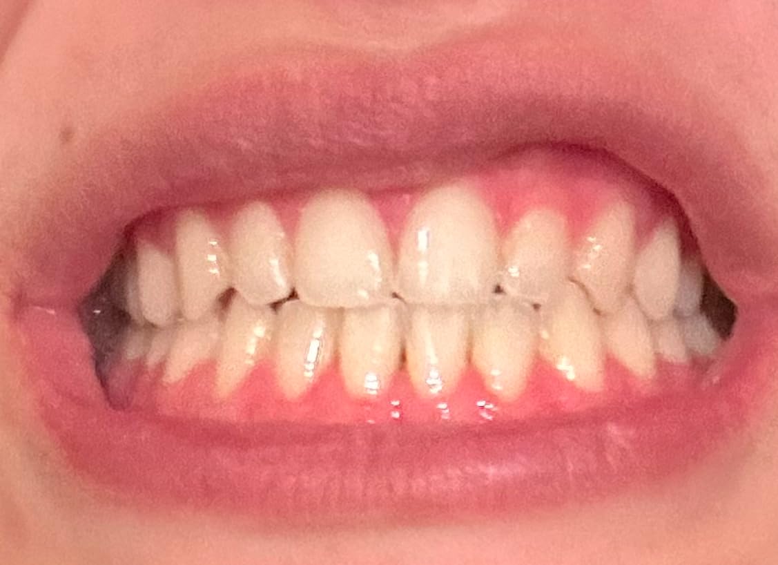 GuruNanda Teeth Whitening Kit - 8% Hydrogen Peroxide Teeth Whitening Gel Pen & Advanced Wireless LED Accelerator Light, Upto 10 Shades Whiter Teeth, Professional Dentist-Inspired System, 40 Treatments customer photo 1