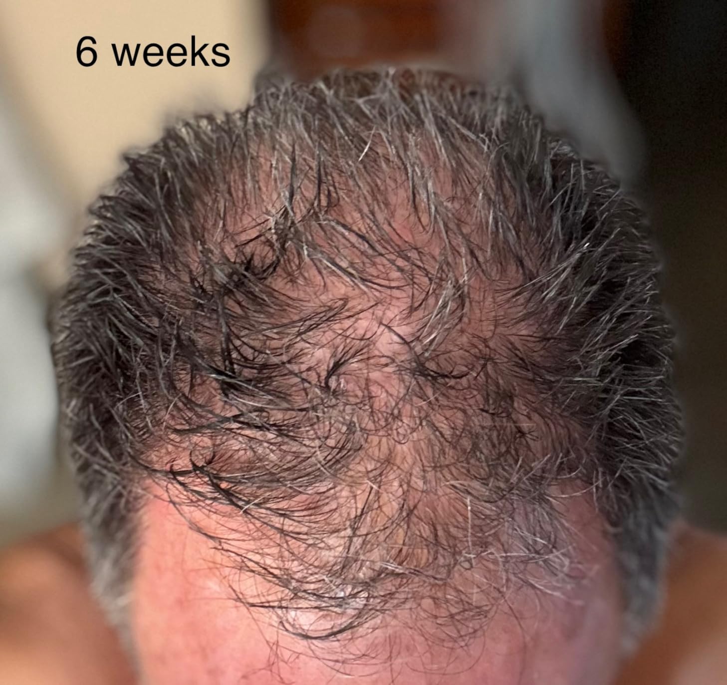 iRestore Professional Laser Red Light Therapy for Hair Growth System - FDA Cleared Hair Loss, Hair Thinning & Alopecia Treatment for Men & Women - 282 Lasers & LEDs customer photo 1